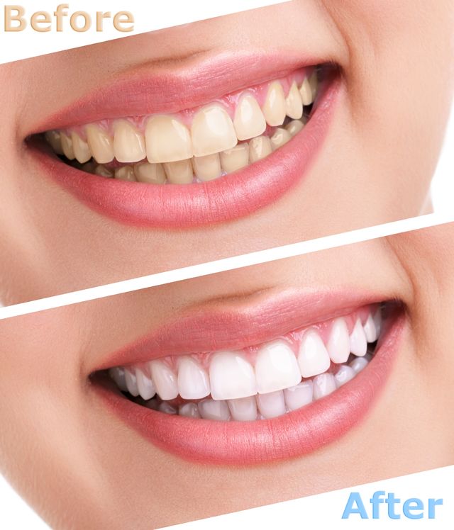 Teeth whitening in Phoenixville for new patients
