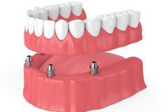 illustrated model of implant supported dentures