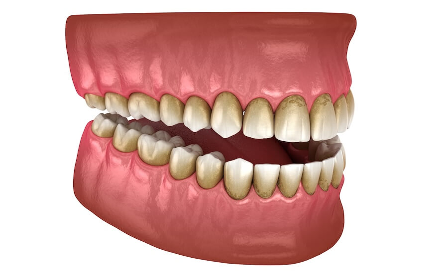 gum disease, periodontal disease, symptoms of gum disease, dental health, plaque accumulation, dentist in phoenixville